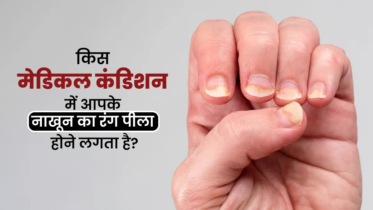 आपके नाखूनों का रंग भी हो रहा है पीला, तो जानें कौन सी मेडिकल कंडीशन हो सकती है इसकी वजह