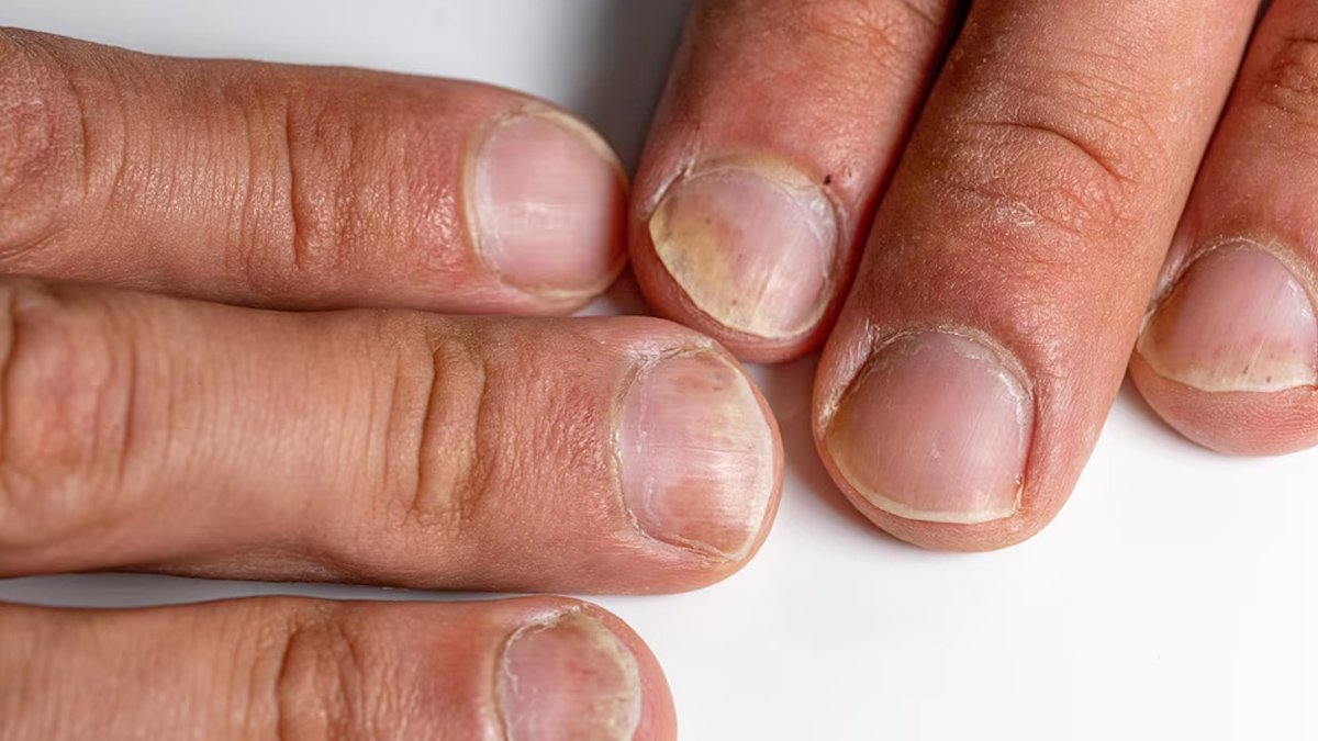 medical-condition-causes-yellow-nails-in