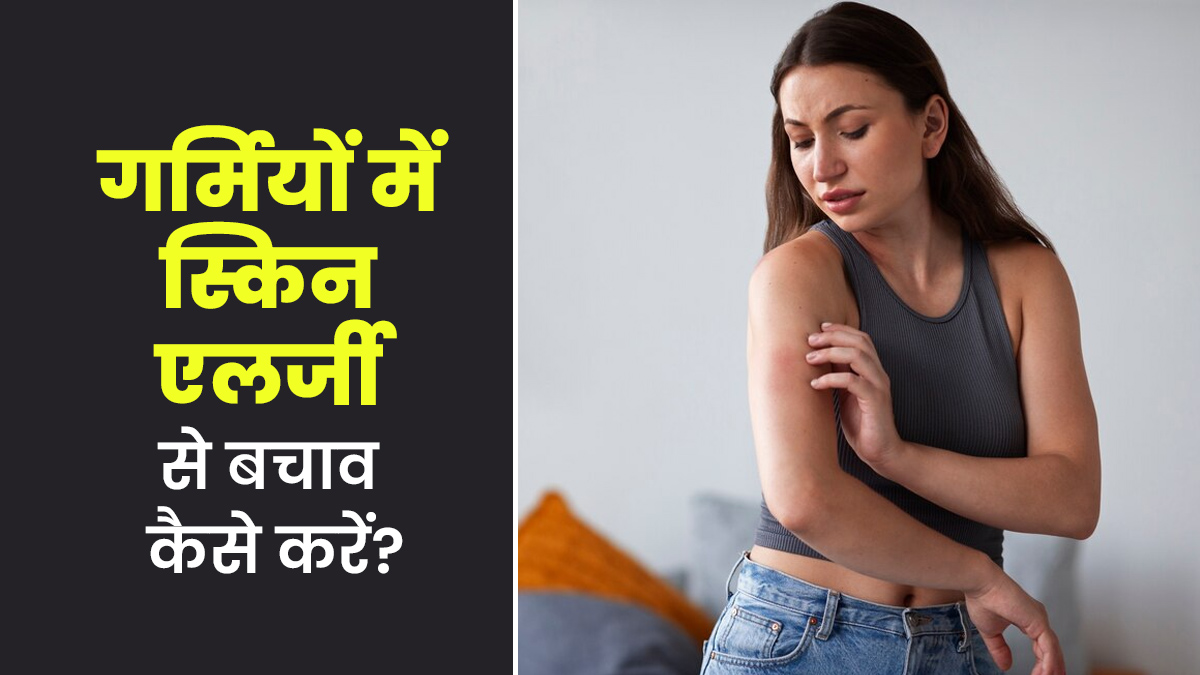गर्मी का मौसम आते ही होने लगती है स्किन एलर्जी? जानें ऐसे में कैसे रखें अपना ख्याल