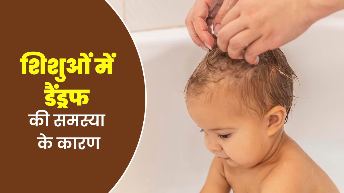 क्या शिशुओं में डैंड्रफ की समस्या हो सकती है? जानें इसके कारण और बचाव के टिप्स