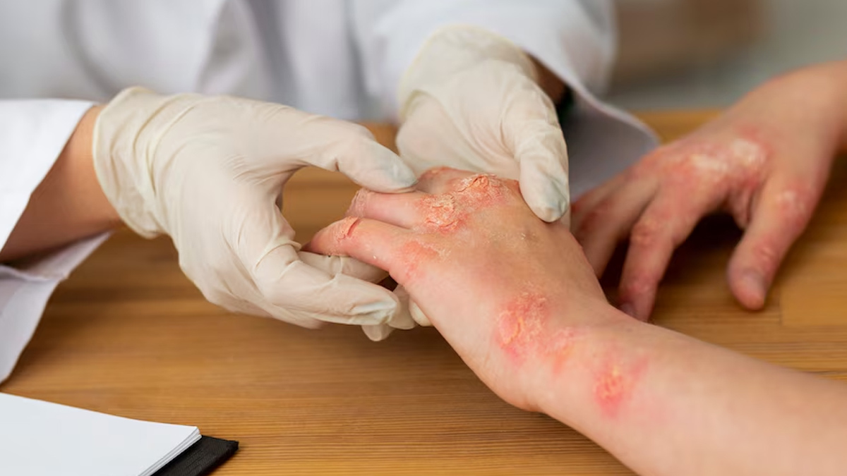 self care tips that can minimise symptoms of psoriasis in hindi 01 (3)