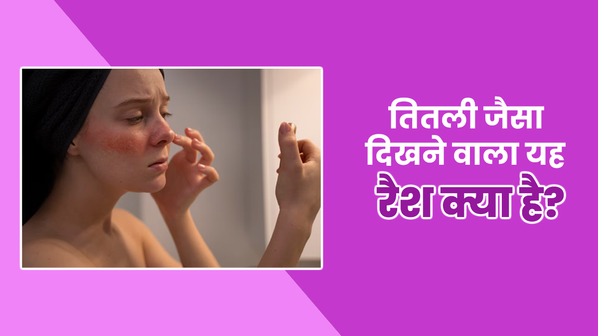 नाक पर तितली के आकार में नजर आते हैं रैशेज, डॉक्टर से जानें इस बटरफ्लाई (मलेर) रैश के बारे में सबकुछ