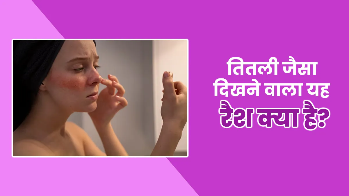 नाक पर तितली के आकार में नजर आते हैं रैशेज, डॉक्टर से जानें इस बटरफ्लाई (मलेर) रैश के बारे में सबकुछ