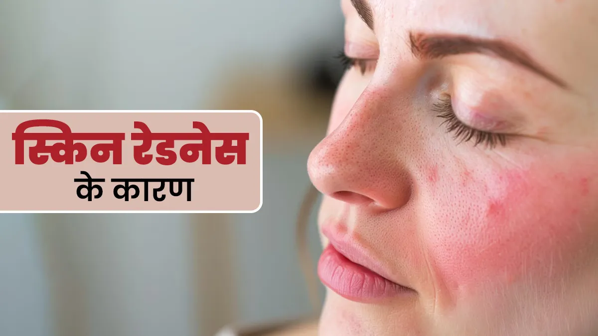 त्वचा लाल होने (स्किन रेडनेस) की वजह बन सकते हैं ये 6 कारण, एक्सपर्ट से जानें