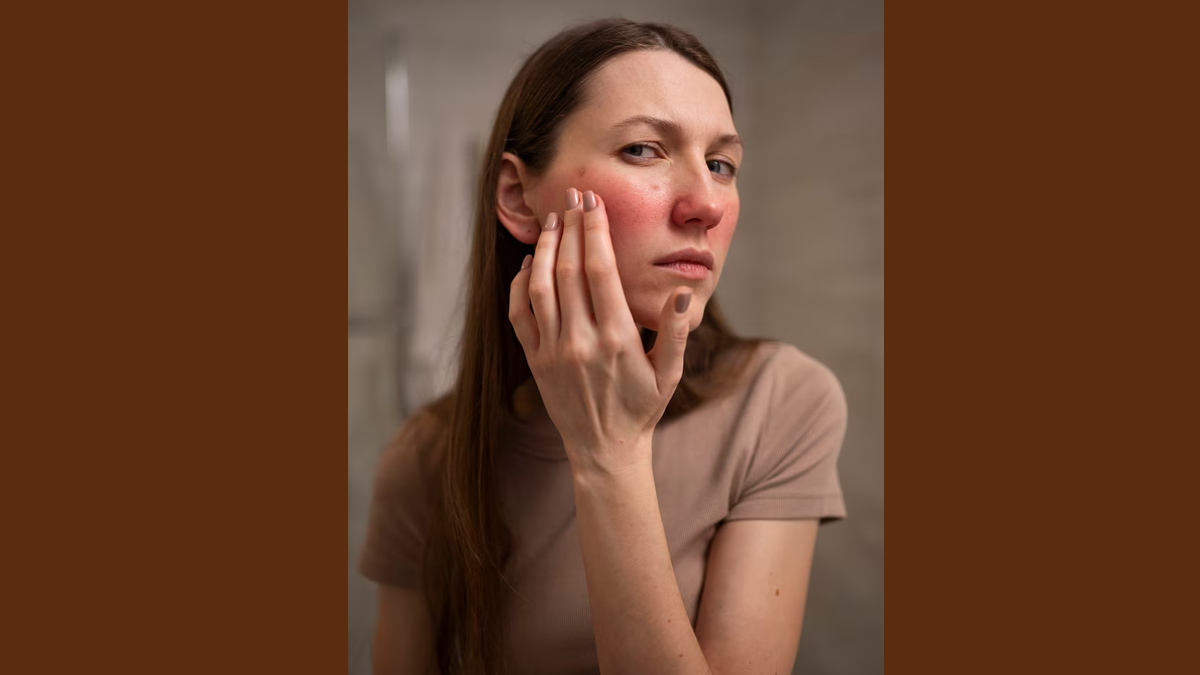 Malar Rash in hindi