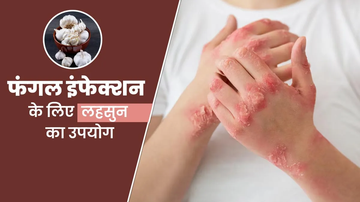 फंगल इंफेक्शन के लिए लहसुन का उपयोग कैसे करें? डॉक्टर से जानें