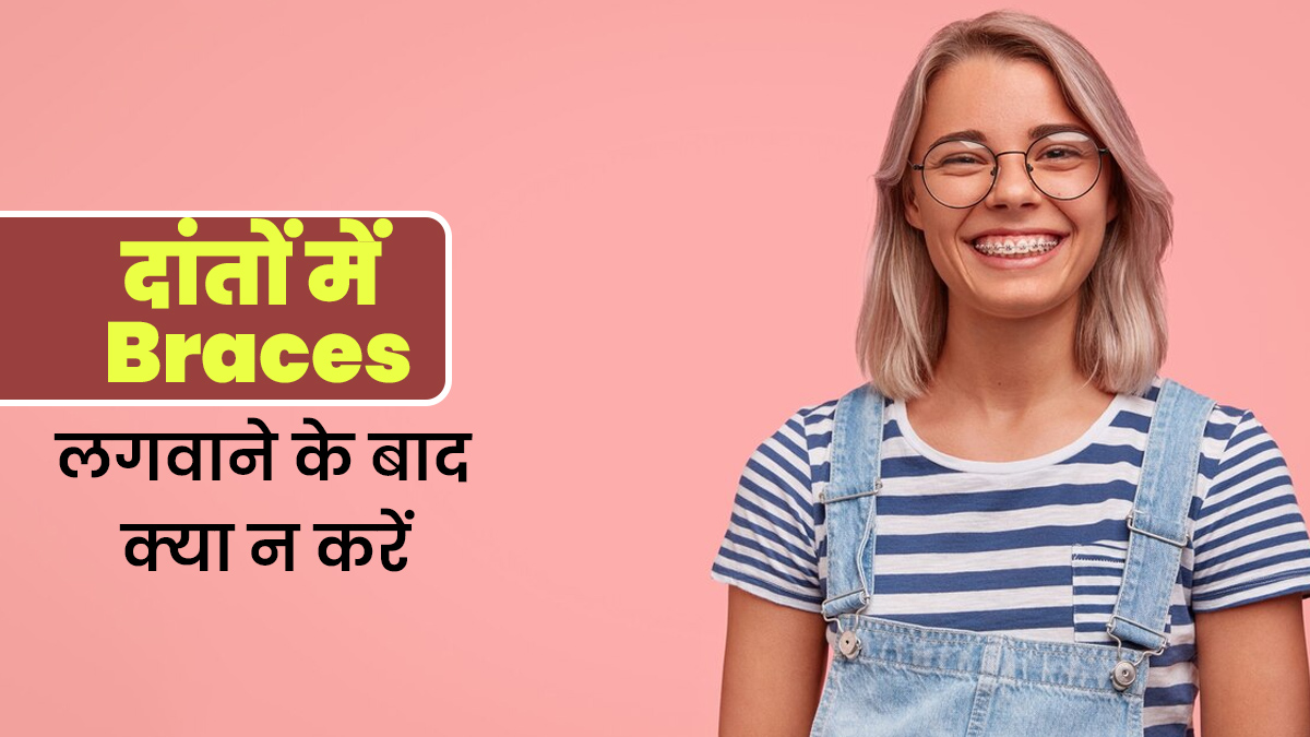 दांतों में ब्रेसेस (Braces) लगवाने के बाद न करें ये 5 काम, हो सकता है भारी नुकसान