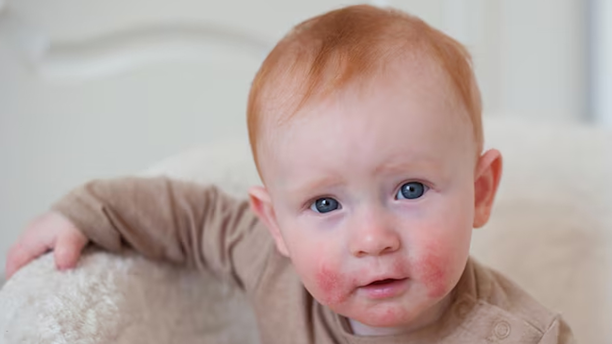 heat rashes in babies
