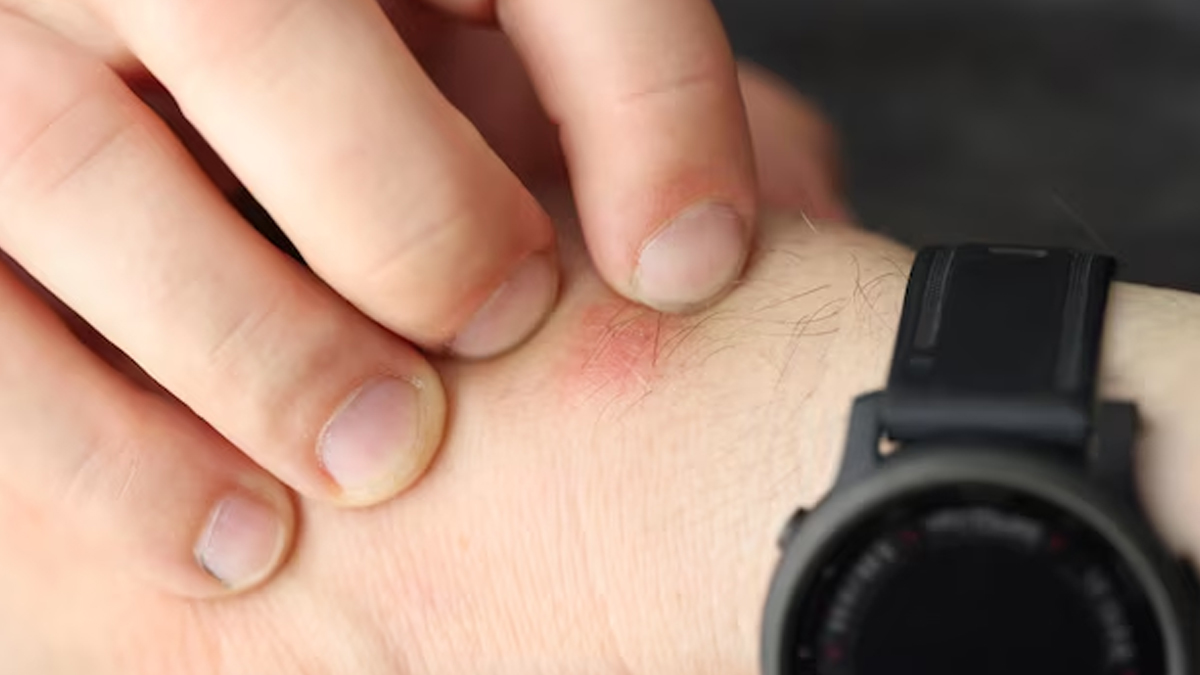 skin-infection-by-watch