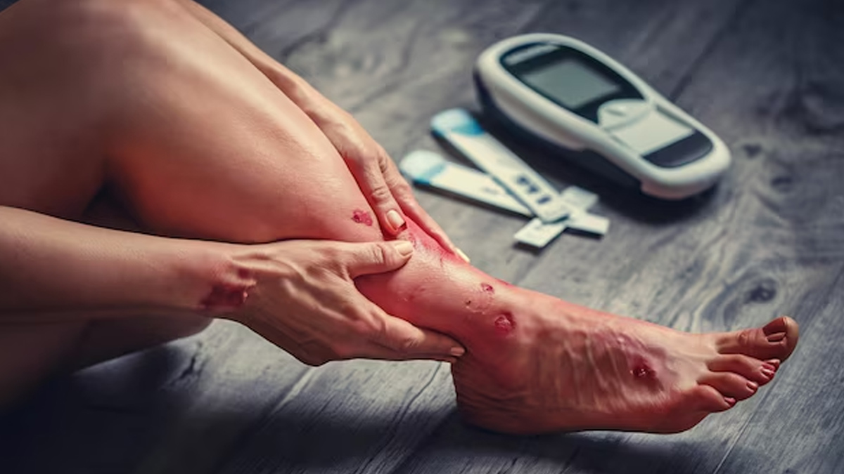 leg-problem-by-diabetes
