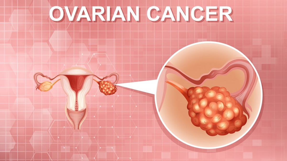 Cause Of Ovarian Cancer