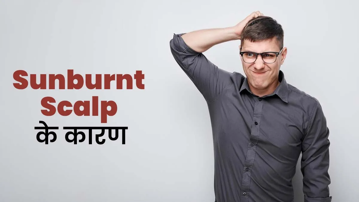 धूप में देर तक रहने से हो सकती है Sunburnt scalp की समस्या? जानें कारण, लक्षण और बचाव टिप्स