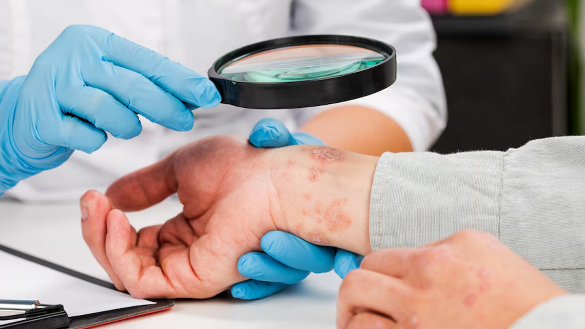 are eczema and asthma related 01 (4)