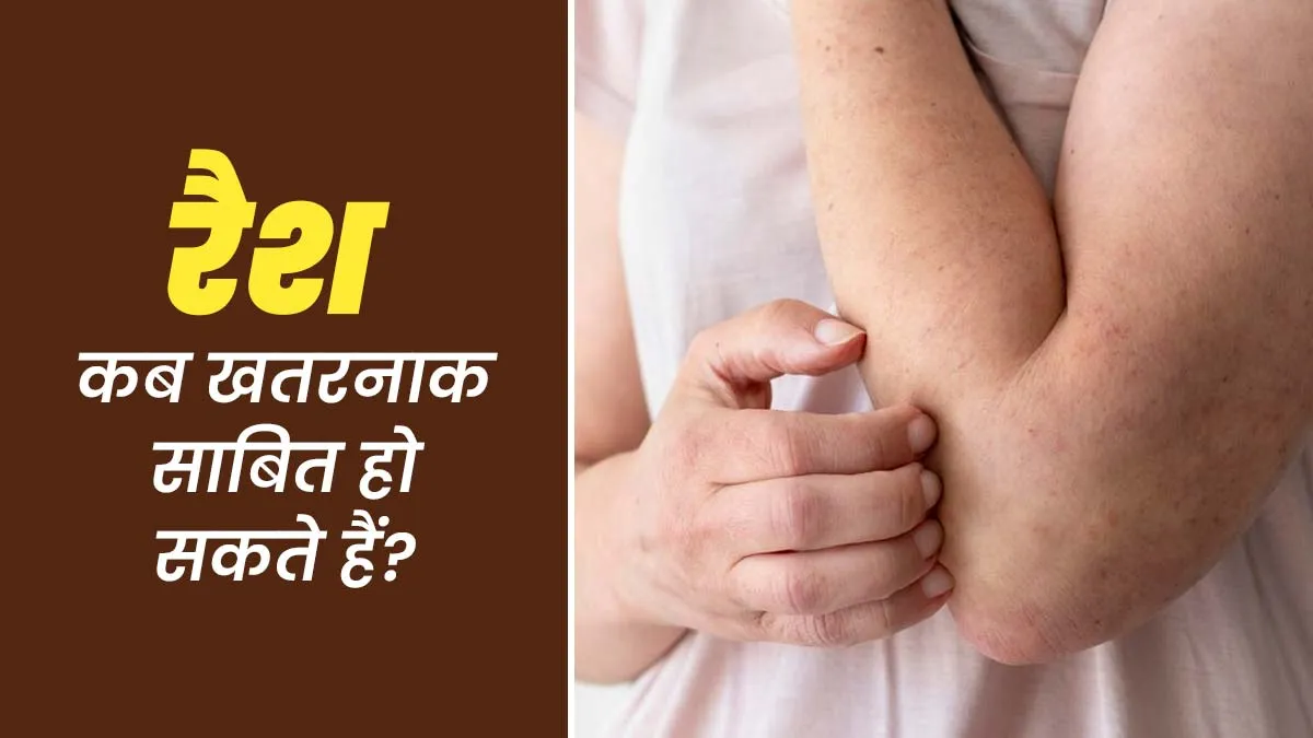 किन संकेतों से समझें की रैश खतरनाक साबित हो सकता है? डॉक्टर से जानें