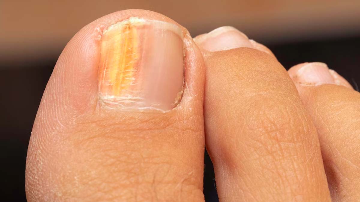 Symptoms and causes of nail psoriasis in