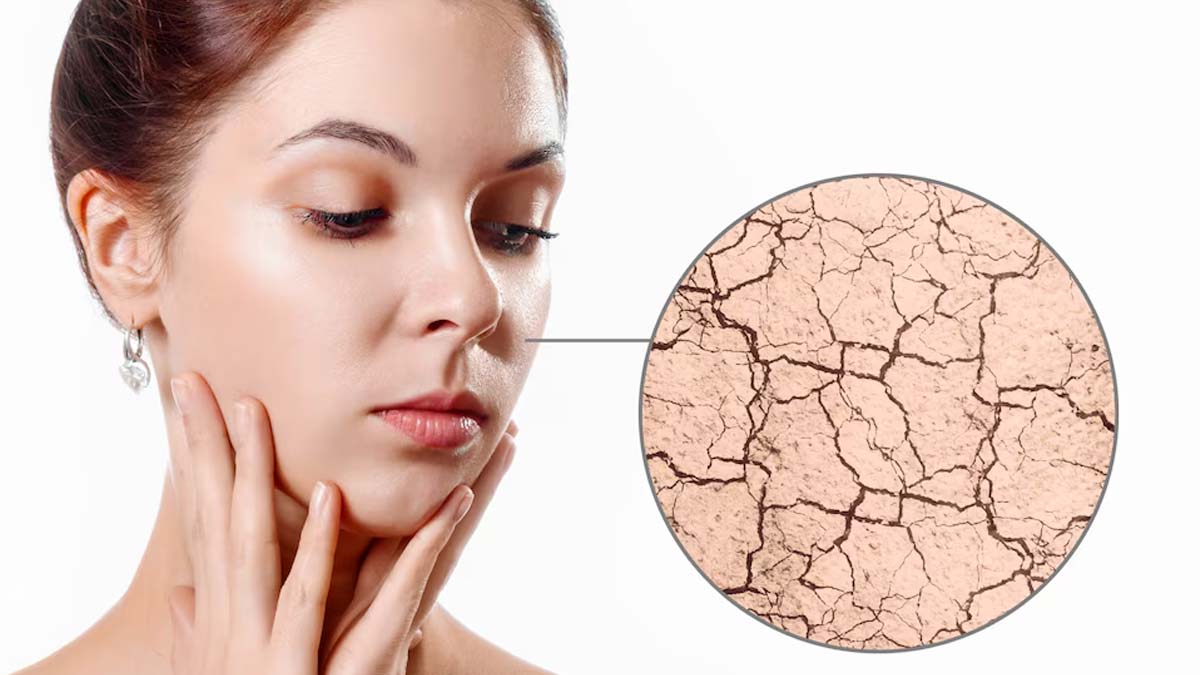 does multani mitti cause dry skin 01 (5)