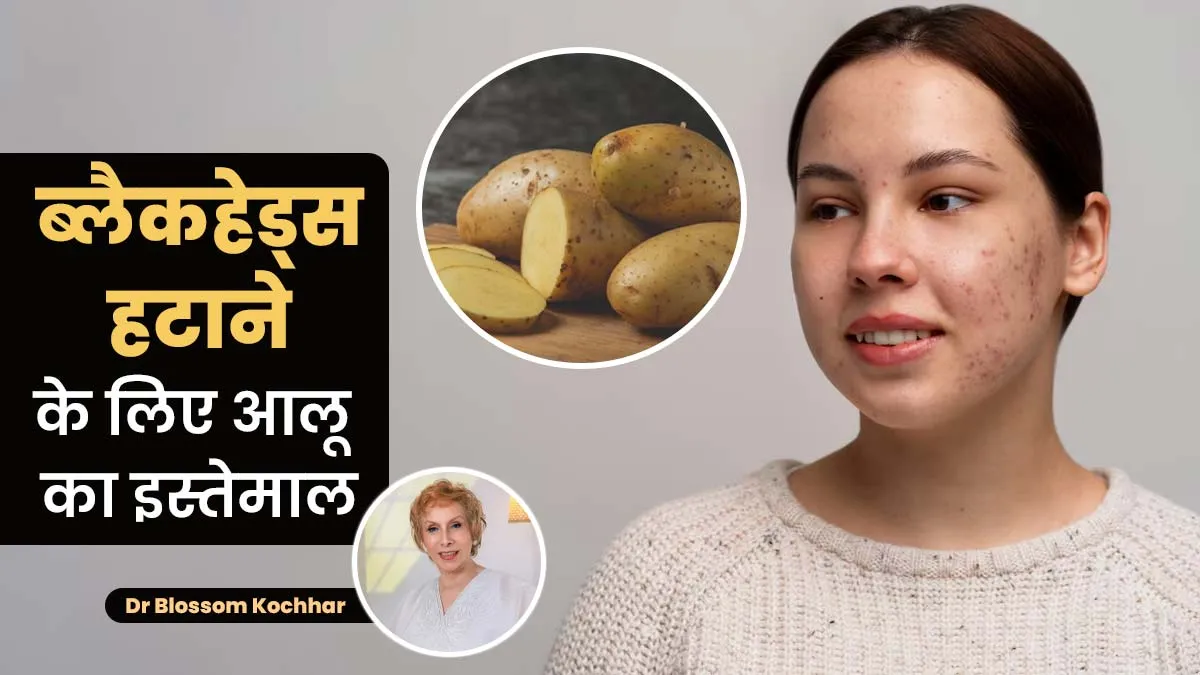 ब्लैकहेड्स हटाने के लिए आलू का उपयोग कैसे करें? एक्सपर्ट से जानें और फिर करें इस्तेमाल