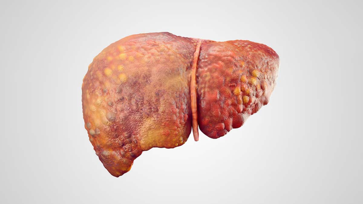 are cashews nuts good for fatty liver in hindi 01 (3)