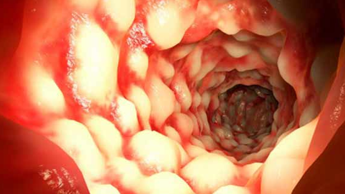 World IBD Day