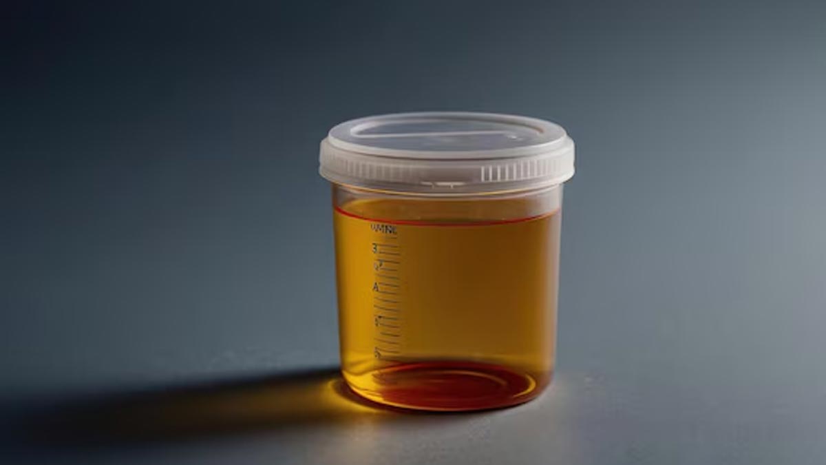 yellow-urine-causes