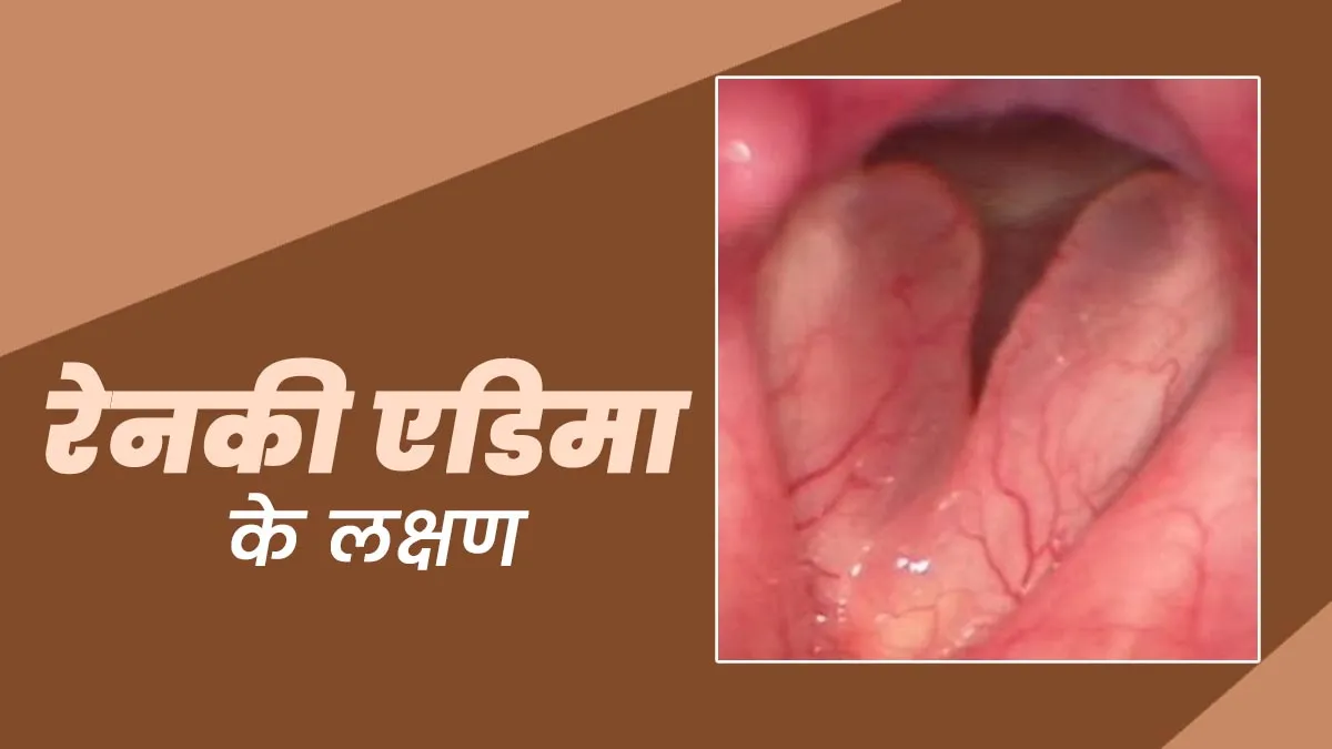 रेनकी एडिमा की समस्या में क्या लक्षण दिखते हैं? एक्सपर्ट से जानें