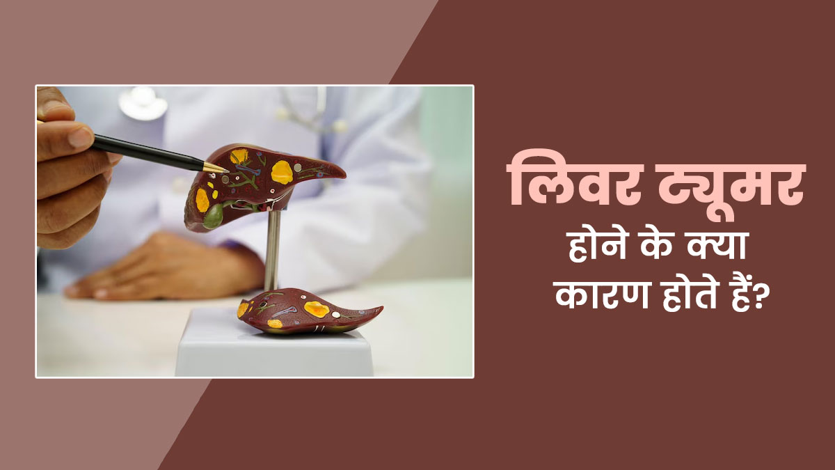 लिवर ट्यूमर होने के क्या कारण होते हैं? डॉक्टर से जानें इसके लक्षण