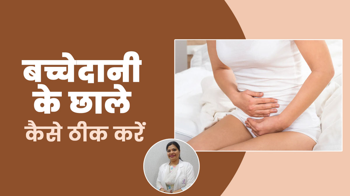 बच्चेदानी के छाले कैसे ठीक करें? जानें डॉक्टर से