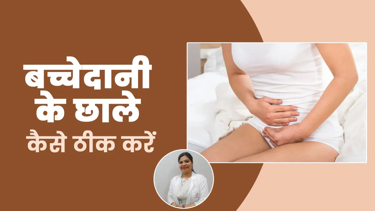 बच्चेदानी के छाले कैसे ठीक करें? जानें डॉक्टर से