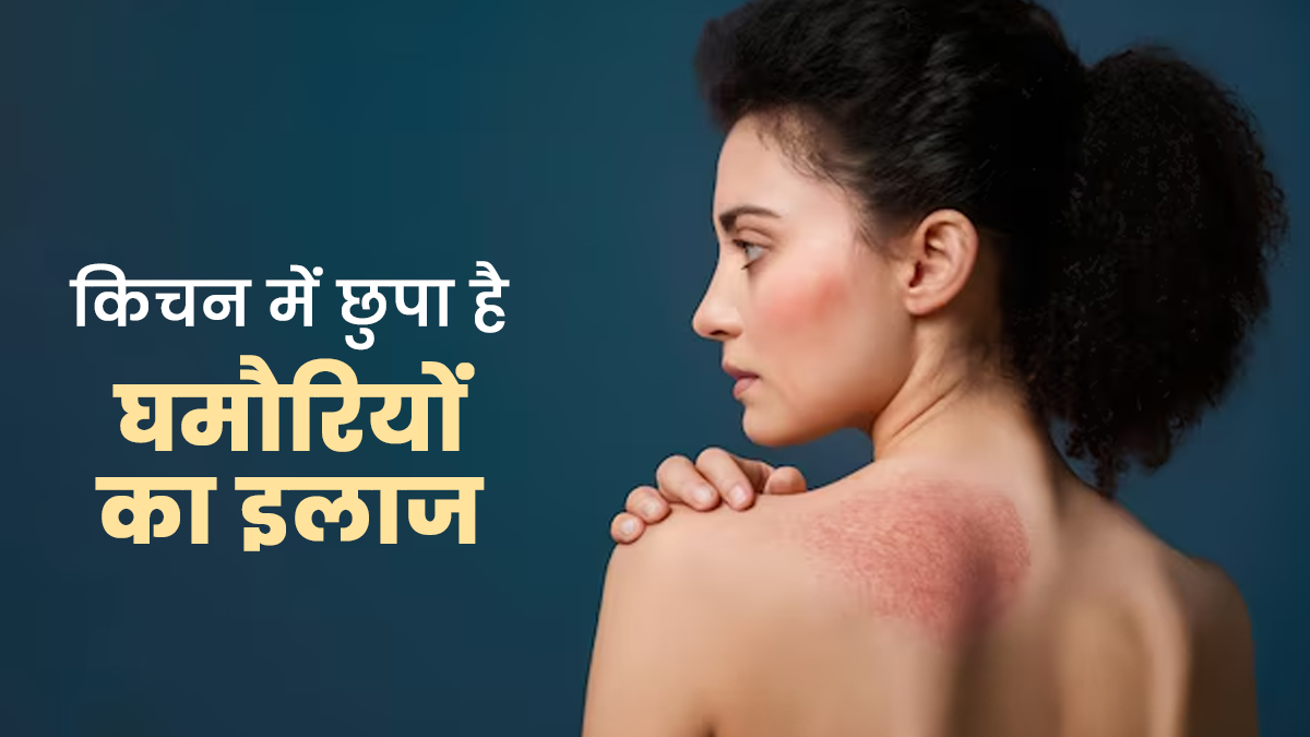 चुभती-जलती घमौर‍ियों को दूर करते हैं क‍िचन के ये 7 इंग्रीड‍िएंट्स, जानें इस्‍तेमाल का सही तरीका