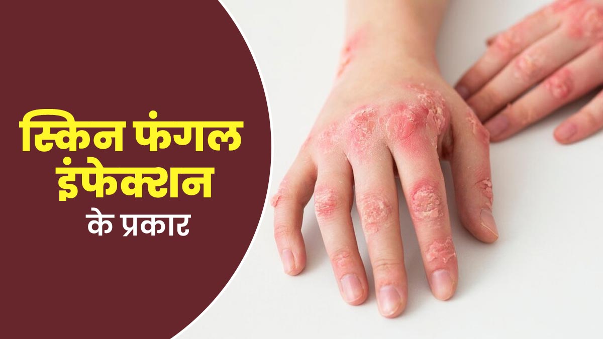 5 तरह के होते हैं स्किन फंगल इंफेक्शन, जानें कौन-सा है सबसे खतरनाक
