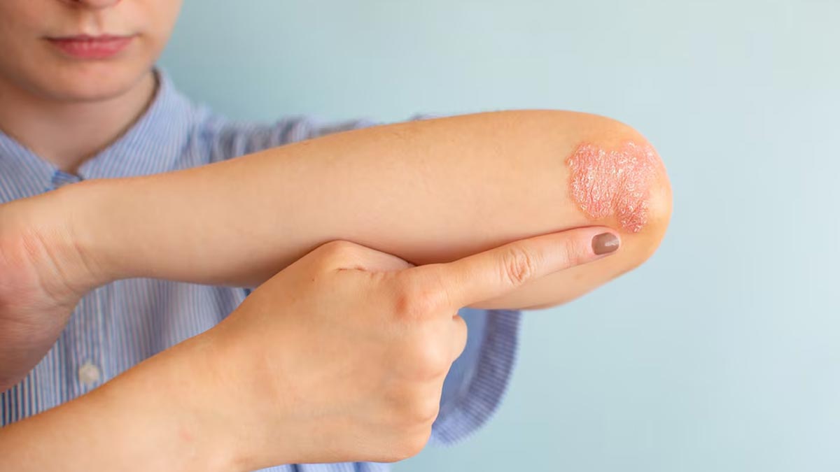 types-of-skin-fungal-infection-Inside