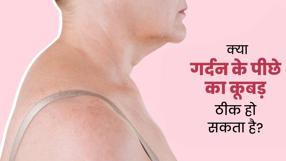 क्या गर्दन के पीछे का कूबड़ ठीक हो सकता है? डॉक्टर से जानें