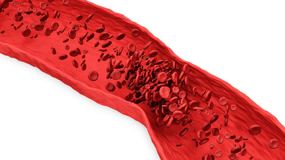 is garlic a blood thinner in hindi 01