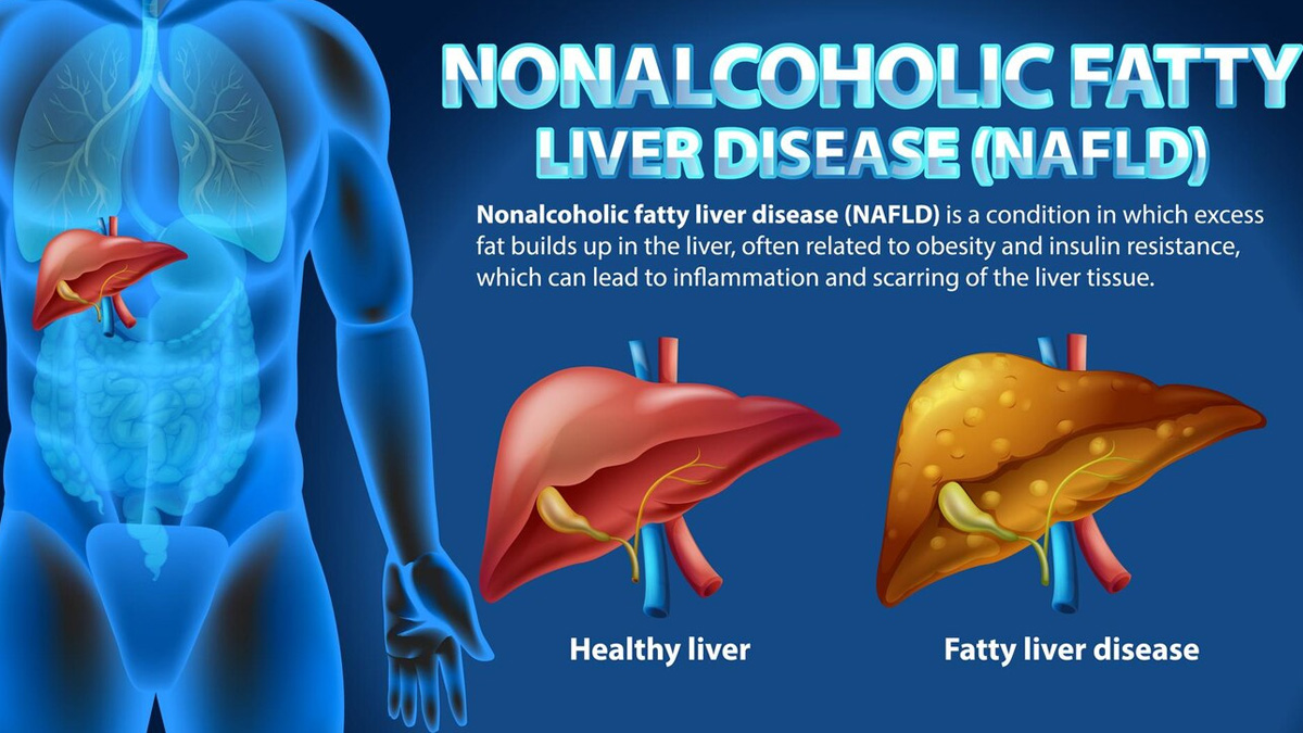 fatty-liver-disease