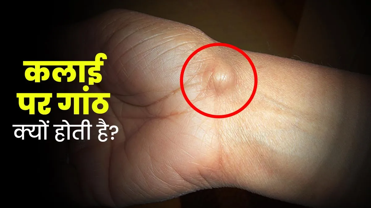 कलाई पर गांठ बनने के पीछे हो सकते हैं ये 5 कारण, जानें डॉक्‍टर को कब द‍िखाएं