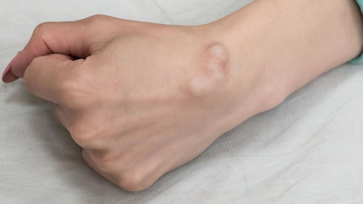 wrist-lump-causes