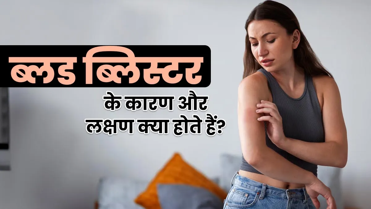 रक्त से भरे फफोले (ब्लड ब्लिस्टर) के क्या लक्षण होते हैं? जानें इस समस्या का कारण