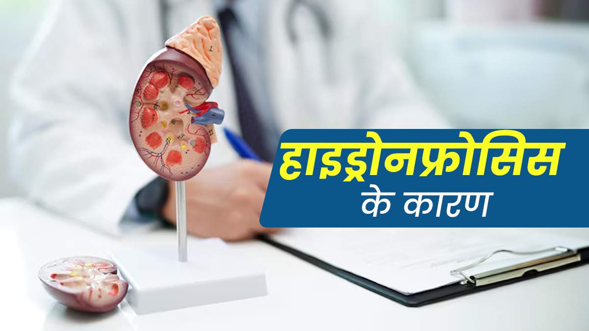 किडनी के आसपास पानी जमा होना हो सकती है हाइड्रोनफ्रोसिस की समस्या, जानें इसके कारण