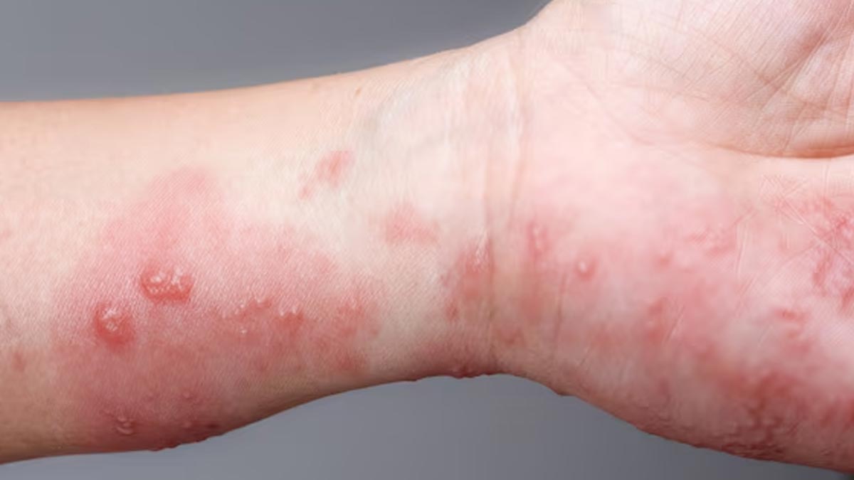 Symptom and causes of blood blister in