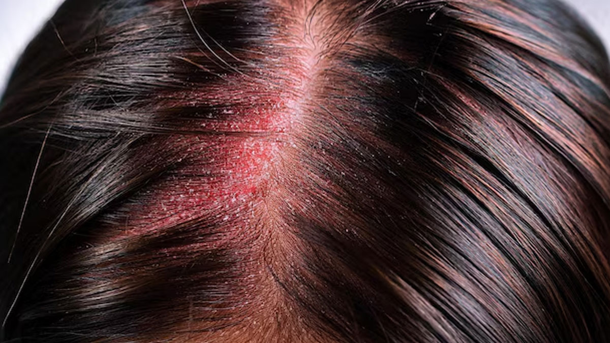 head-allergy-in-hindi