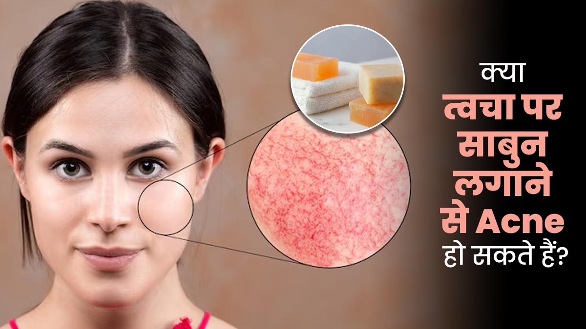 क्या त्वचा पर साबुन लगाने से एक्ने की दिक्कत हो सकती है? जानें क्या कहते हैं स्किन स्पेशलिस्ट