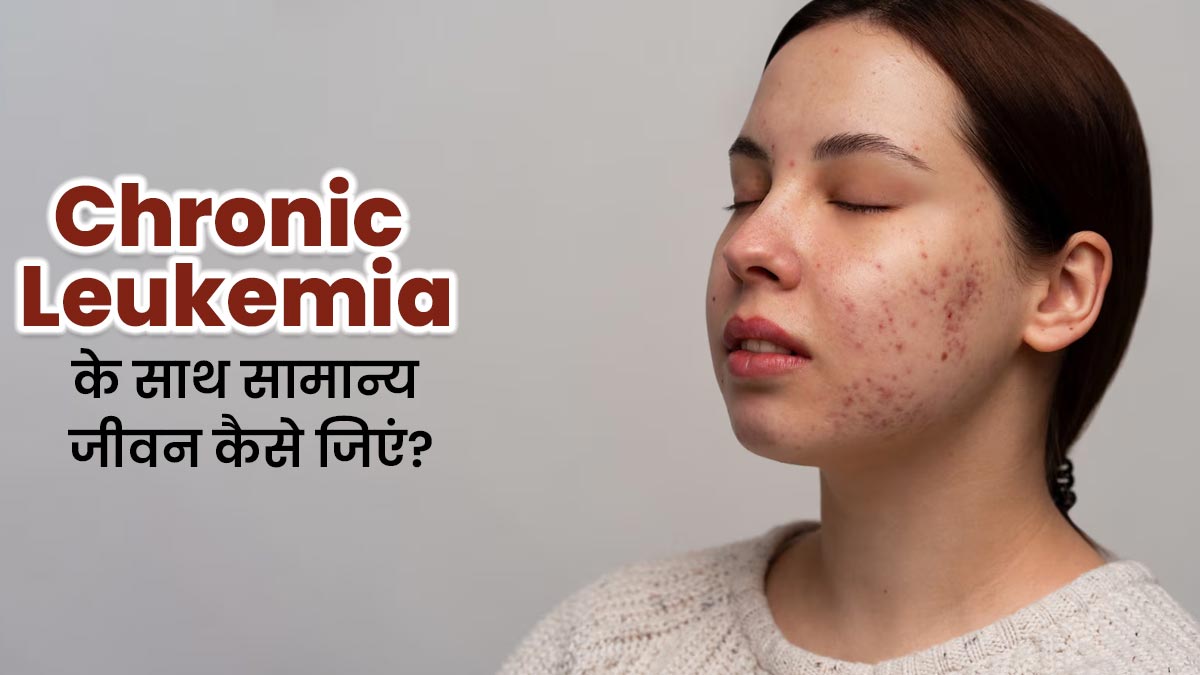 क्रोनिक ल्यूकेमिया के साथ कैसे जिएं सामान्य जीवन? डॉक्टर के ये 5 टिप्स करेंगे आपकी मदद