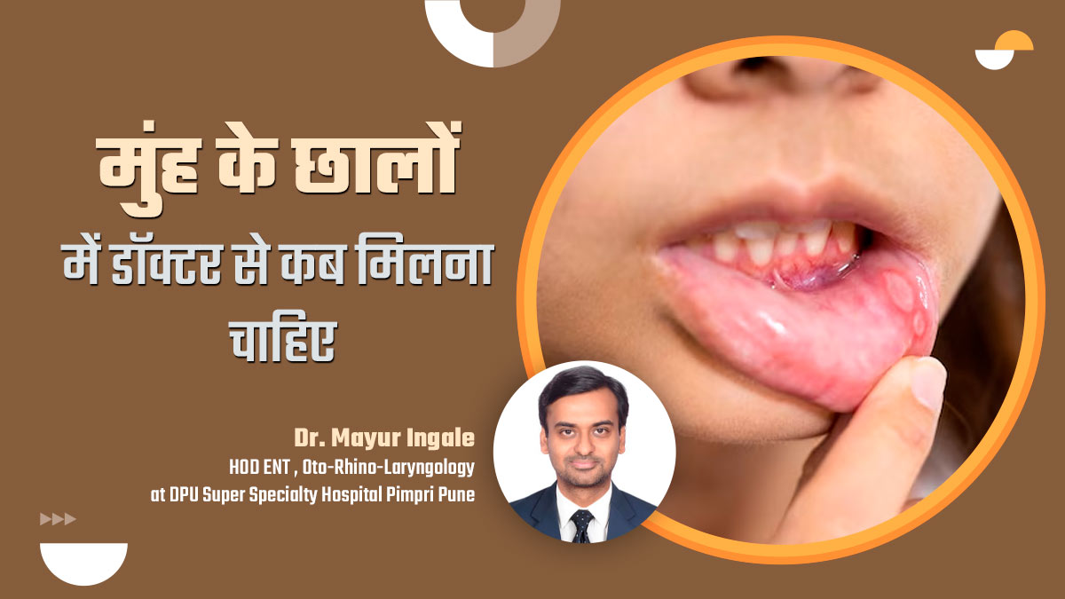 मुंह में बार-बार छाले होने पर डॉक्टर के पास कब जाएं? एक्सपर्ट से जानें