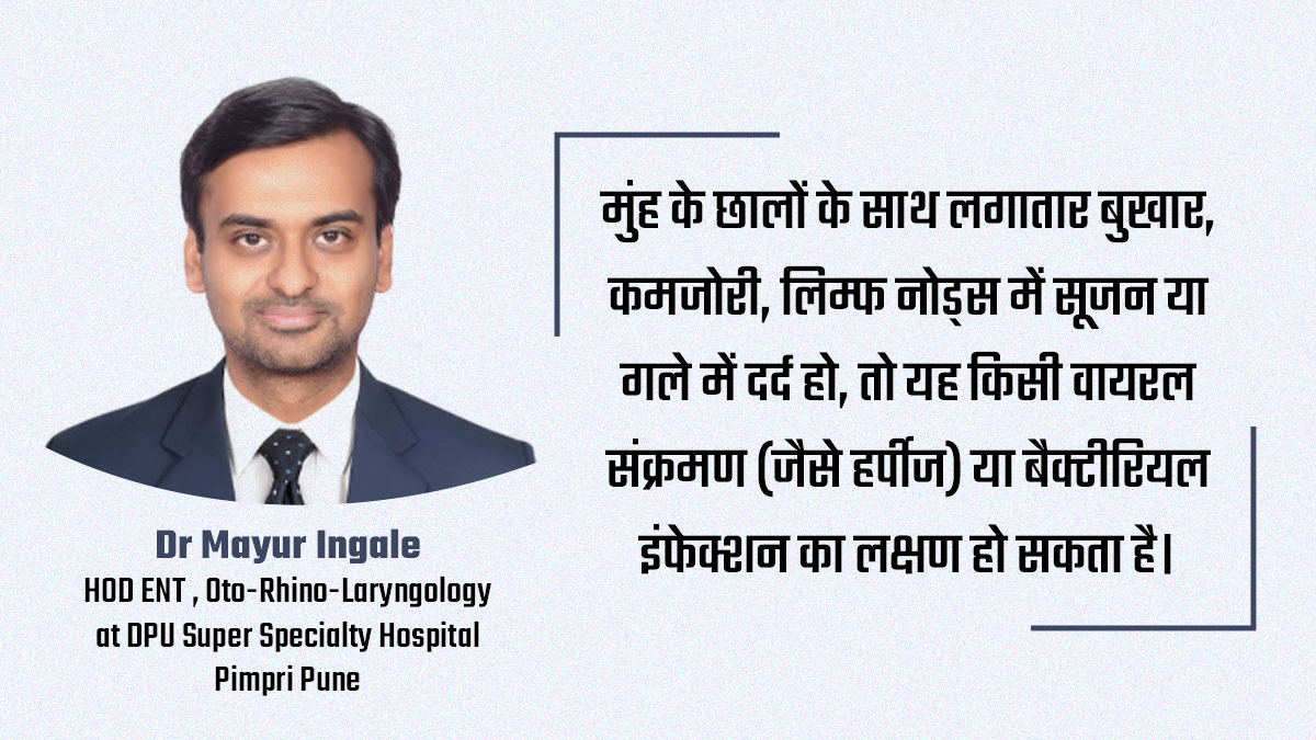 मुंह के छालों के बारे में डॉक्टर को कब दिखाना चाहिए |  When should I go to the doctor for a mouth ulcer | Muh ke chale theek Kaise karen mouth-ulcer-inside