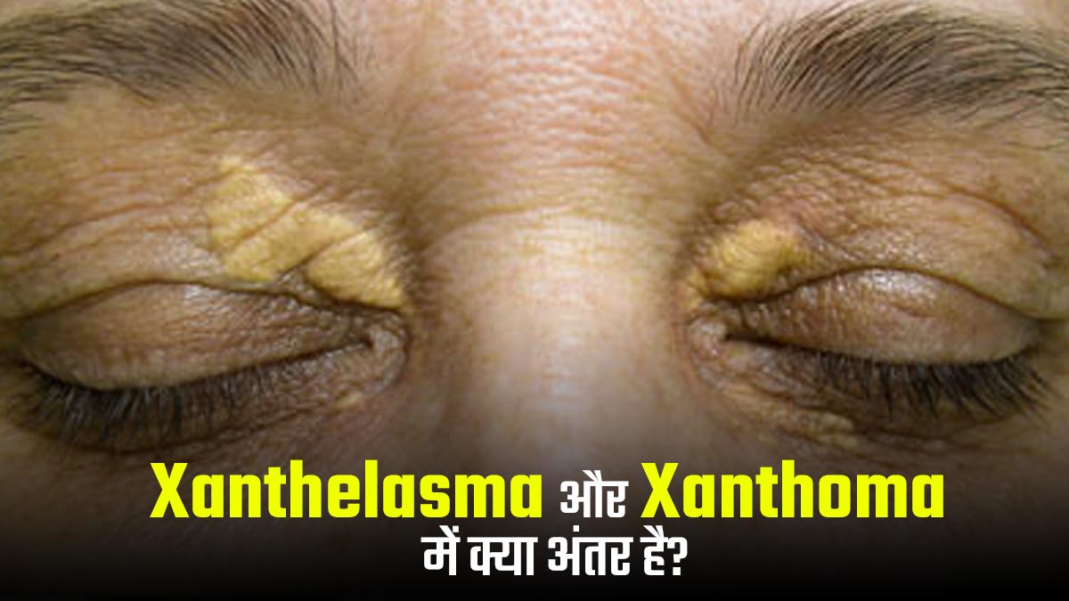Xanthelasma और Xanthoma में क्या अंतर है? एक्सपर्ट से जानें त्वचा से जुड़ी इन समस्याओं के बारे में