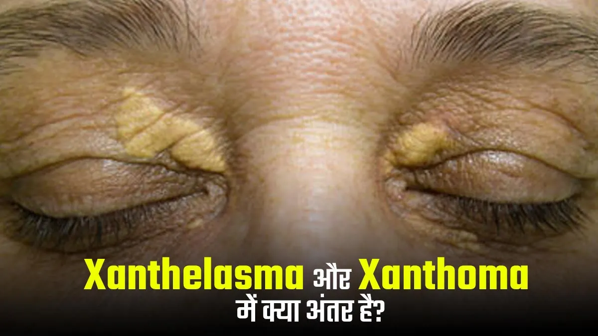 Xanthelasma और Xanthoma में क्या अंतर है? एक्सपर्ट से जानें त्वचा से जुड़ी इन समस्याओं के बारे में