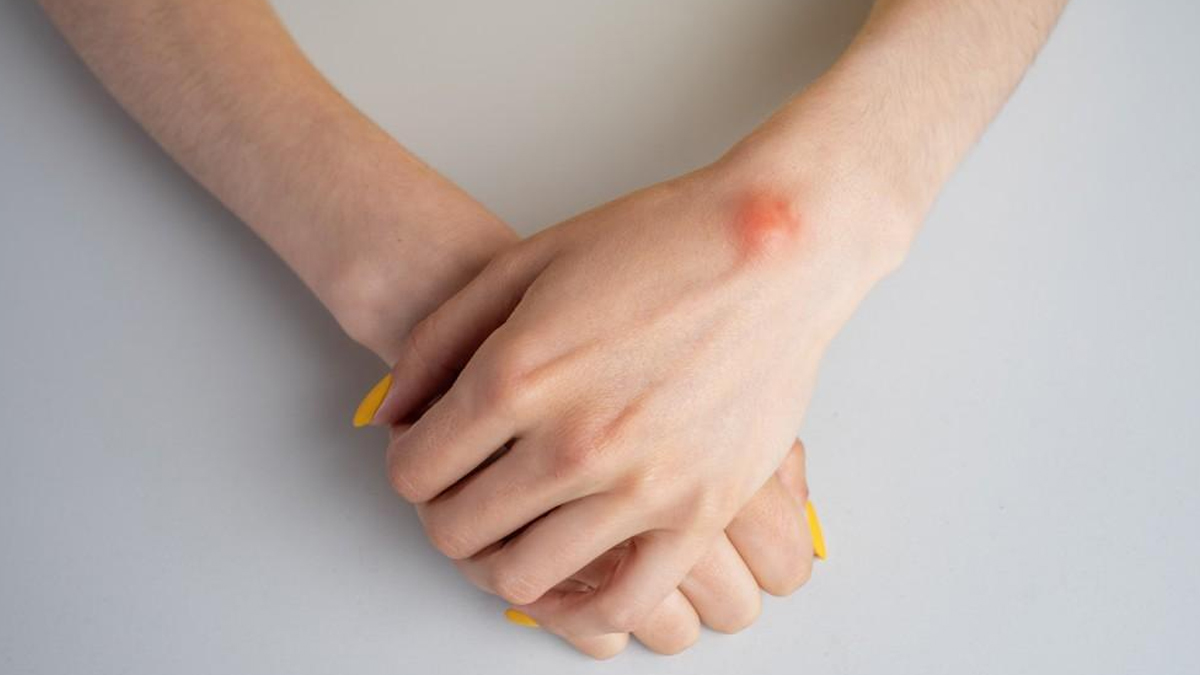 lipoma-and-lymphoma