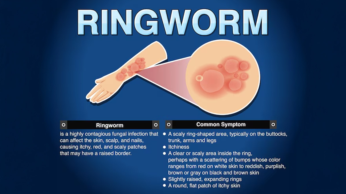ringworm-prevention-in-hindi
