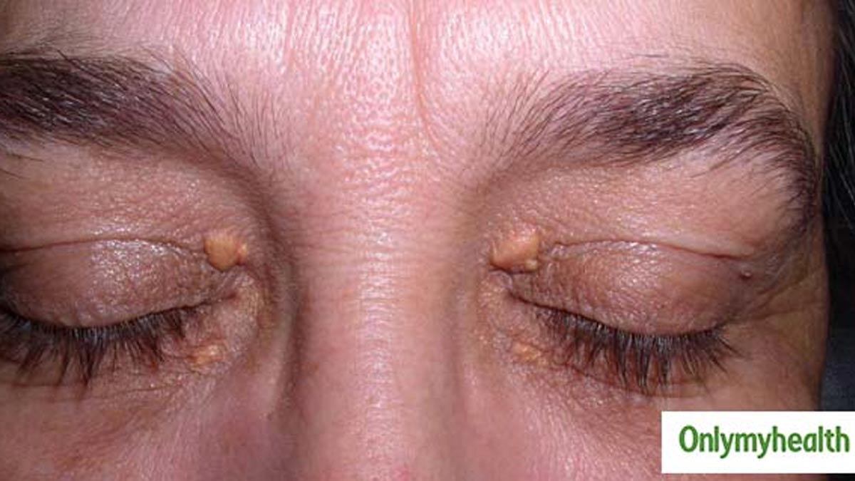 xanthelasma and xanthoma difference between these skin conditions in hindi main (5)