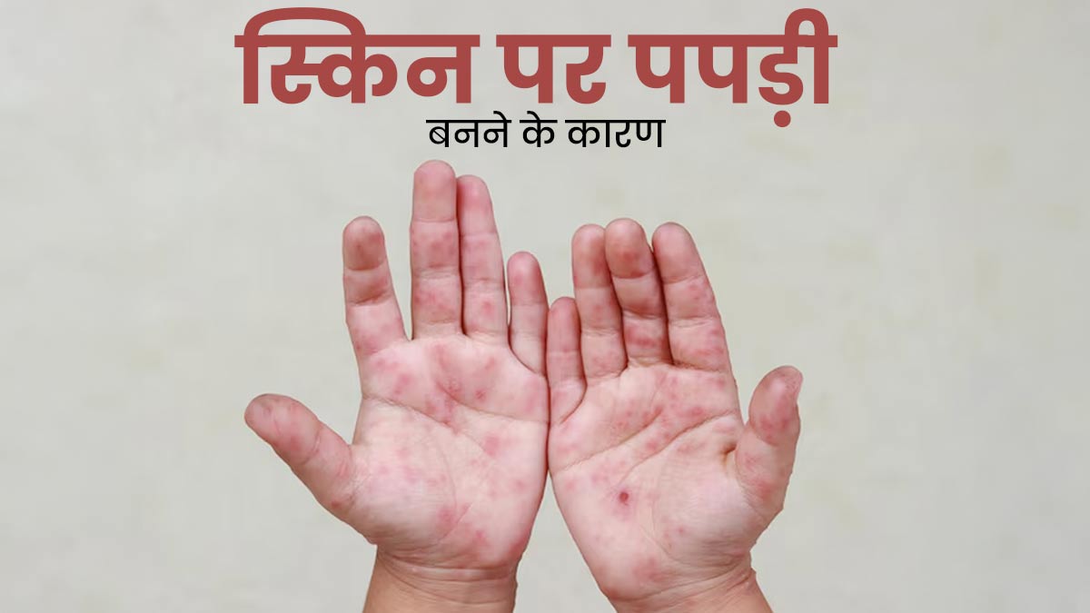 स्किन पर बहुत ज्यादा पपड़ी बनना इक्थियोसिस का हो सकता है संकेत, जानें इसके कारण